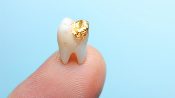 Zhotovení zubní výplně v Dobrý Dent: Kvalita a péče na Praze 5