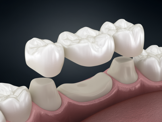Zubní můstky: Spolehlivé řešení pro Váš úsměv v Praze