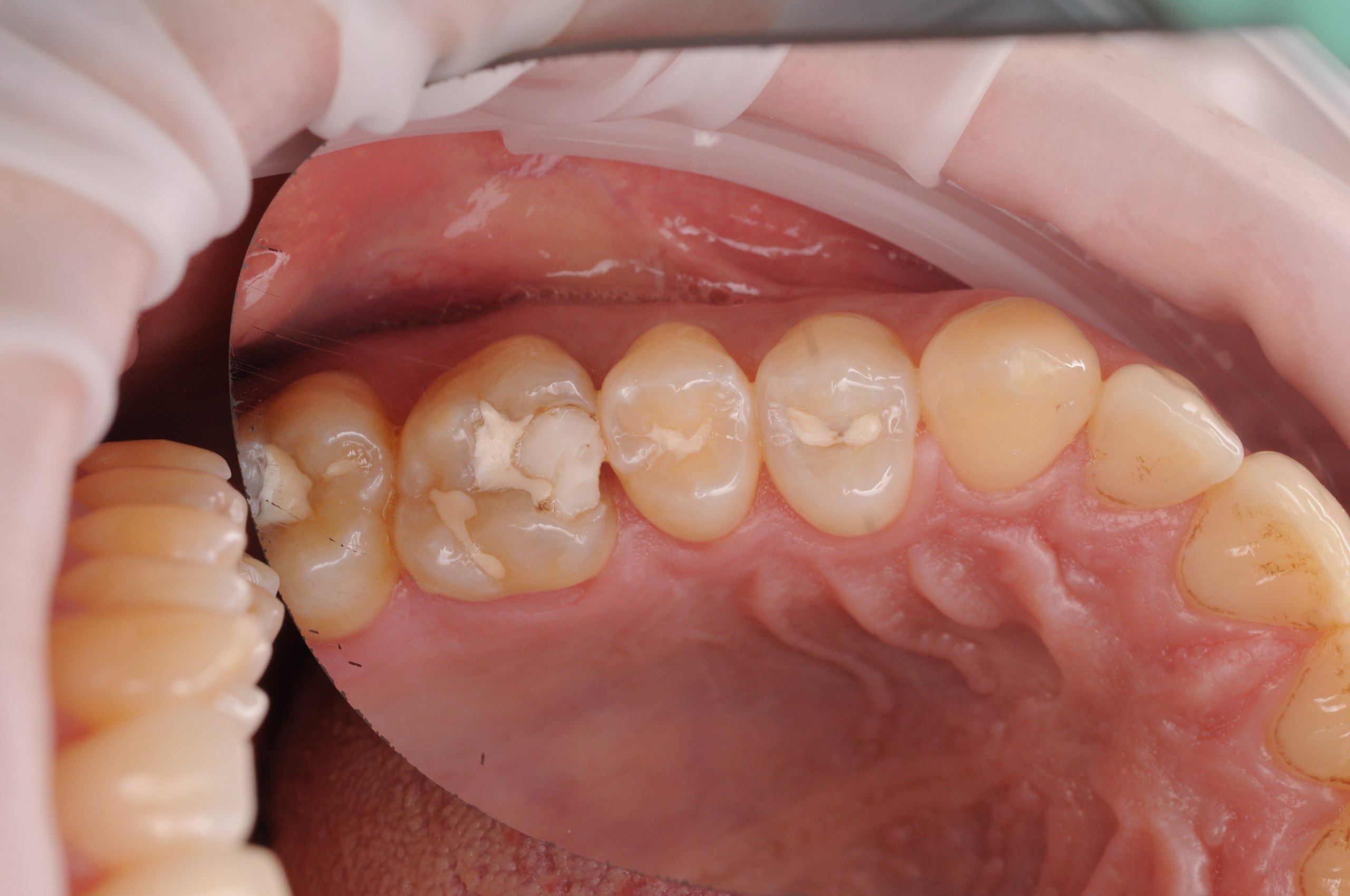 Реставрація - Před