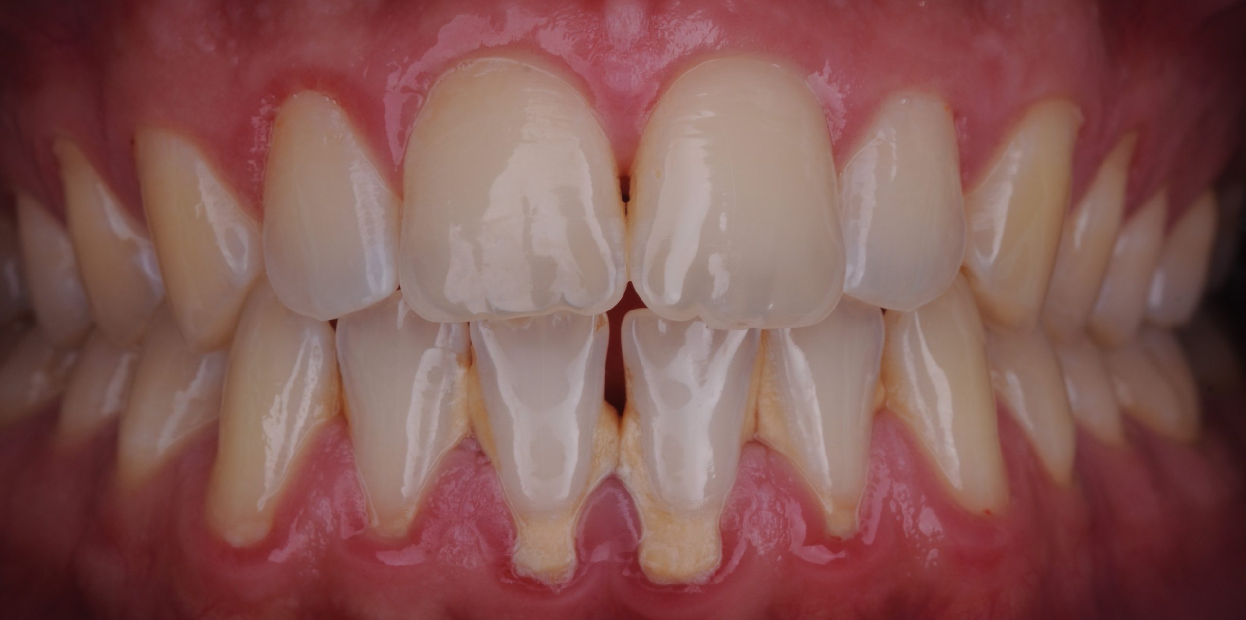 Гигиена - Před