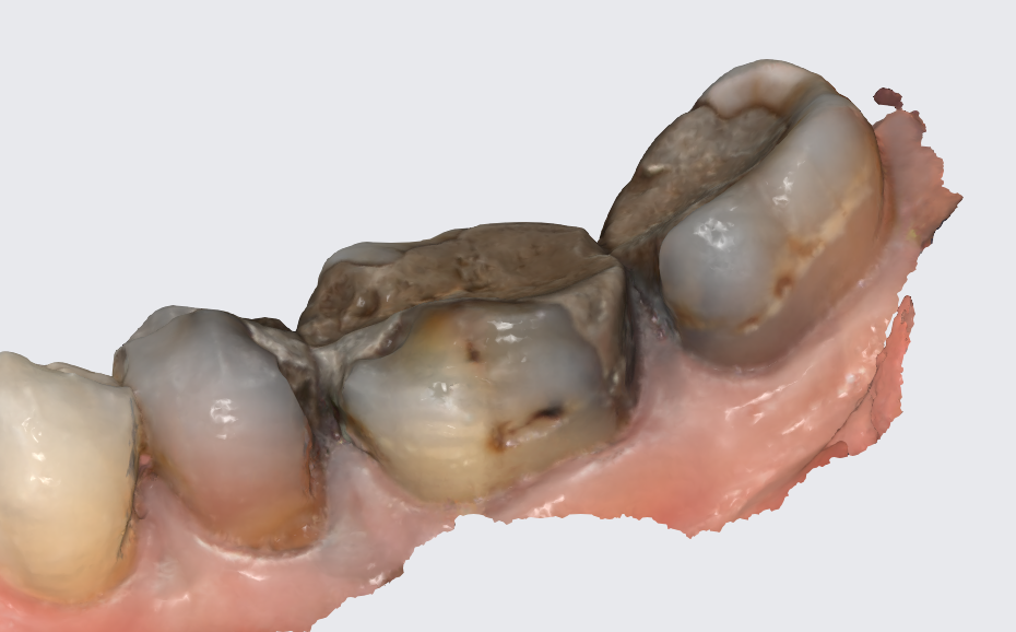 Коронка - Před