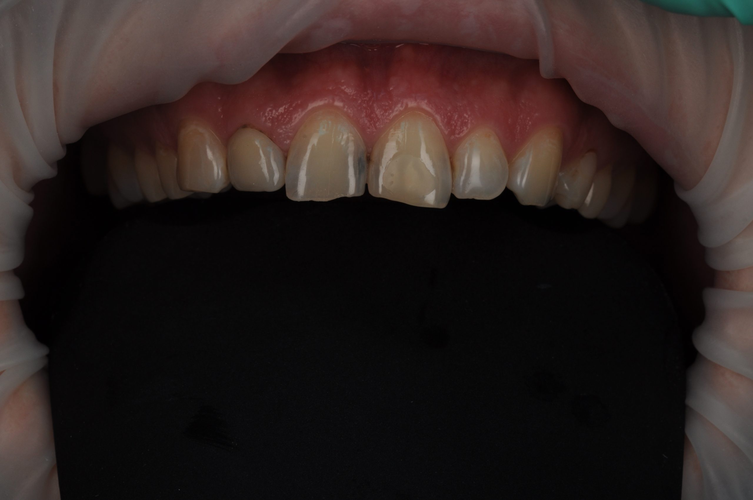 Виниры - Před